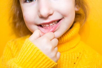 Girl shows her teeth-pathological bite, malocclusion, overbite. Pediatric dentistry and periodontics, bite correction. Health and care of teeth, caries treatment, baby teeth. Upper jaw rests on gum.