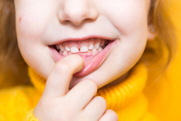 Girl shows her teeth-pathological bite, malocclusion, overbite. Pediatric dentistry and periodontics, bite correction. Health and care of teeth, caries treatment, baby teeth. Upper jaw rests on gum.