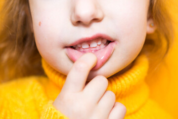 Fototapeta premium Girl shows her teeth-pathological bite, malocclusion, overbite. Pediatric dentistry and periodontics, bite correction. Health and care of teeth, caries treatment, baby teeth. Upper jaw rests on gum.