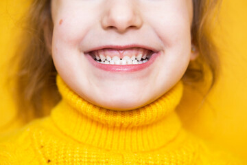 Girl shows her teeth-pathological bite, malocclusion, overbite. Pediatric dentistry and...