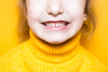 Girl shows her teeth-pathological bite, malocclusion, overbite. Pediatric dentistry and periodontics, bite correction. Health and care of teeth, caries treatment, baby teeth. Upper jaw rests on gum. © Ольга Симонова