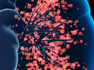 Viral lung infection, illustration