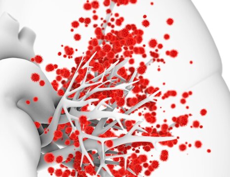 Viral lung infection, illustration