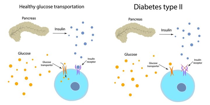 Diabetes type 2 and healthy glucose metabolism, illustration