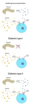 Diabetes and healthy glucose metabolism, illustration