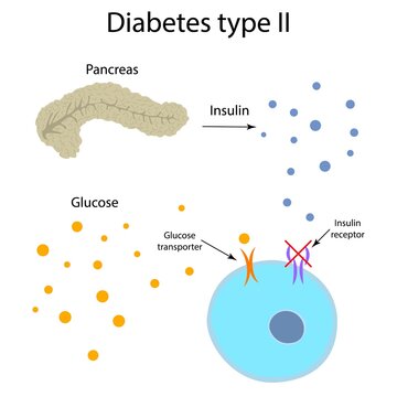 Diabetes type 2, illustration