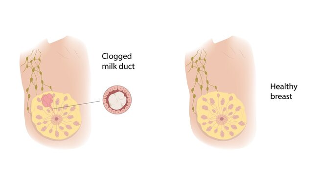 Healthy breast and clogged milk duct, illustration