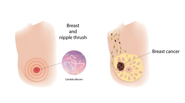 Breast thrush and breast cancer, illustration