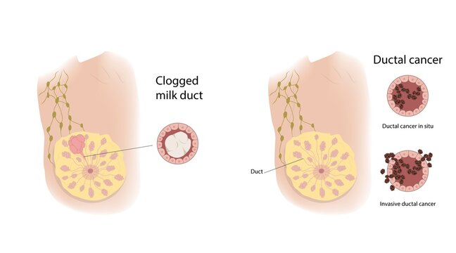 Clogged milk duct and ductal cancer, illustration