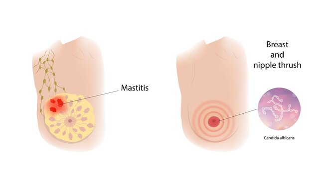 Mastitis and nipple thrush, illustration