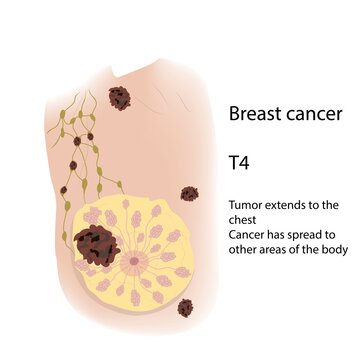 Breast cancer at stage T4, illustration