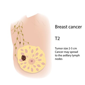 Breast cancer at stage T2, illustration