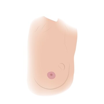 Breast lump, illustration