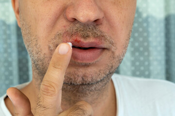 Man applies a cream to herpes virus infection on the lip with his finger. Medical care photo