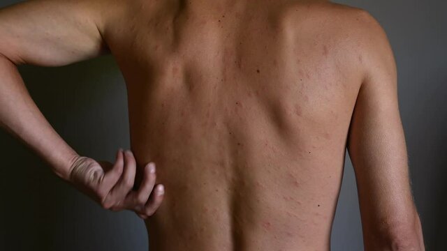 Rash on the body, red eruptions from measles or chickenpox. Infectious Diseases and Treatment. 