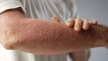 Extreme closeup of woman showing dry scaly skin rash hives on her arm Shown on white background.