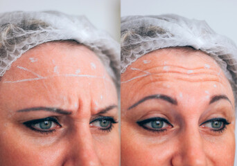 Mimic wrinkles on the frontal area and between the eyebrows, drawing graphic markings on the...