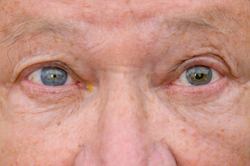 Eyes of a senior man showing unequal pupil dilation