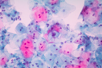 View in microscopic of Abnormal human cervix cells.Squamous epithelium cells.Superficial and intermediate epithelial cells.Cytology and pathology laboratory department.Magnification 400 X