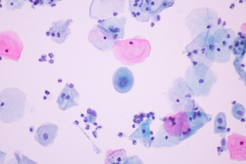 View in microscopic of Abnormal human cervix cells.Squamous epithelium cells.Superficial and intermediate epithelial cells.Cytology and pathology laboratory department.Magnification 400 X