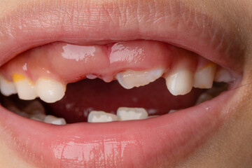 Selective Focus Child's teeth. An 8 year old little girl lost a baby incisor. Children's dentistry and oral hygiene concept. Macro shoot