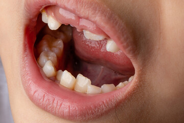 Selective Focus Child's teeth. An 8 year old little girl lost a baby incisor. Children's dentistry and oral hygiene concept. Macro shoot