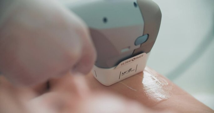 Close-up lifting procedure on the arm by using the Ultraformer apparatus. 