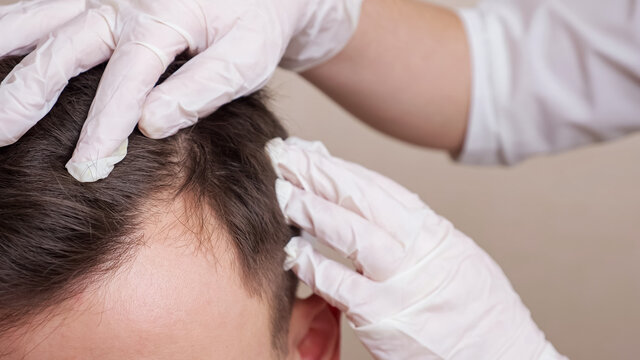 medical worker in gloves examines the head of a balding man close-up.