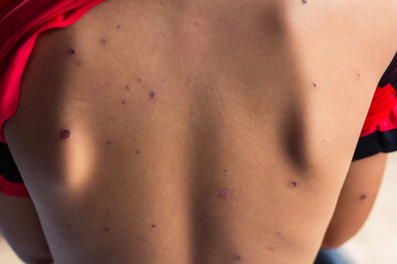 scars from chicken pox, scar on boy back