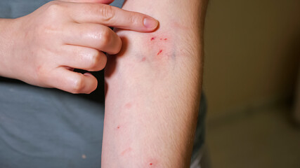 Woman points out scratches and bites on her arm.