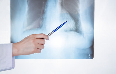 Female doctor's hand using pen to pointing lung X-ray film of COVID-19 patient on glowing screen board