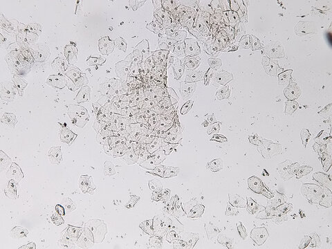 Epithelial cells with bacteria in patient urine (urinary tract infections), analyze by microscope 40x objective.