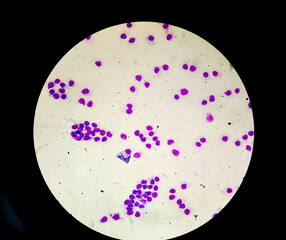 Blood smear under microscopy showing on Adult acute myeloid leukemia (AML) is a type of cancer in...