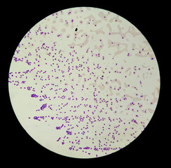 Blood smear under microscopy showing on Adult acute myeloid leukemia (AML) is a type of cancer in...