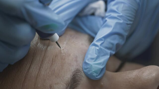 Woman patient at the reception of a cosmetologist dermatologist. Smoothes forehead wrinkles with cryoplasma and argon coagulation surgery. Plasma lifting and facelift. Anti aging treatments.