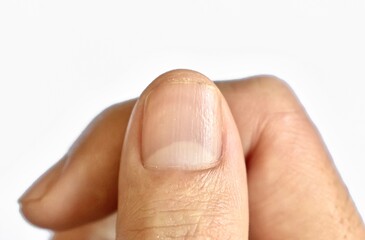 Large lunulae or half-moon at fingernail with longitudinal lines of Southeast Asian, young man....