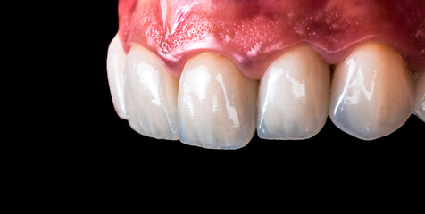 press ceramic crowns and veneers