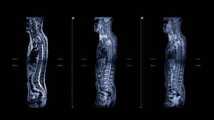 MRI of whole spine  T2W  , T1FS and T1FS with Gadolnilum contrast sagittal  plane for diagnostic Spinal Cord Compression. - obrazy, fototapety, plakaty