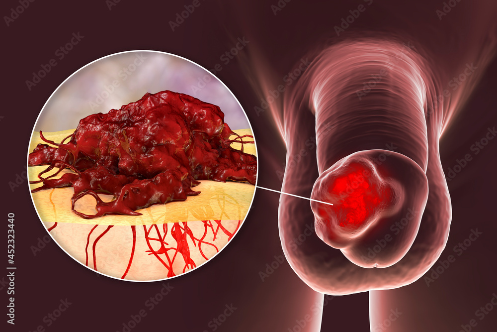 Poster penile cancer, 3d illustration showing malignant tumor on the human penis