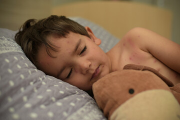 young boy infected with varicella