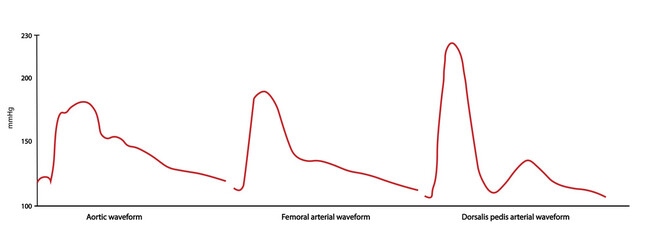 Invasive blood pressure monitoring. Aortic, femoral and dorsalis pedis waveform