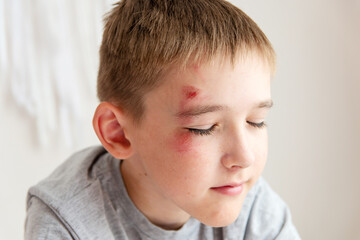 Portrait of a boy of 10 years with an abrasion on his face from a fall or fight.