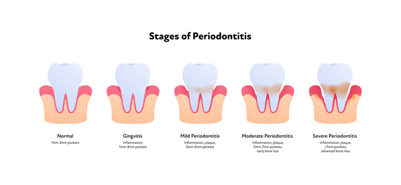 Tooth anatomy and decay chart. Vector biomedical illustration. Side view. Stages of teeth periodontitis illness isolated on white background. Design for healthcare, dentistry