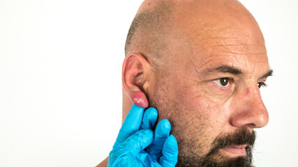 doctor with blue gloves examining an abscess with pus on a swollen and inflamed ear of a caucasian man