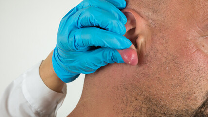 doctor with blue gloves examining an abscess with pus on a swollen and inflamed ear of a caucasian man