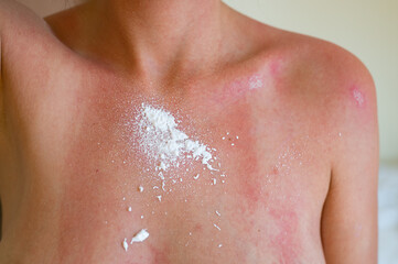Woman with sunburn on her chest. Protective aerosol is applied to sunburn on woman's skin.