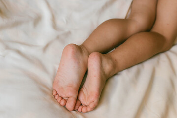 Rash of enterovirus infection picornavirus families on the feet of a 3-year-old child. Medicine, health concept.