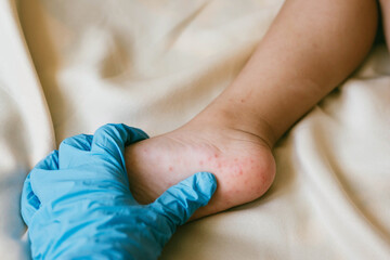 Rash of enterovirus infection picornavirus families on the feet of a 3-year-old child. Medicine, health concept.