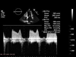Image of the heart in gray-scale mode during transesophageal ultrasound.