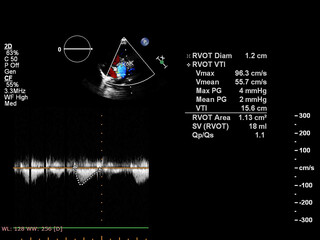 Image of the heart in gray-scale mode during transesophageal ultrasound.
